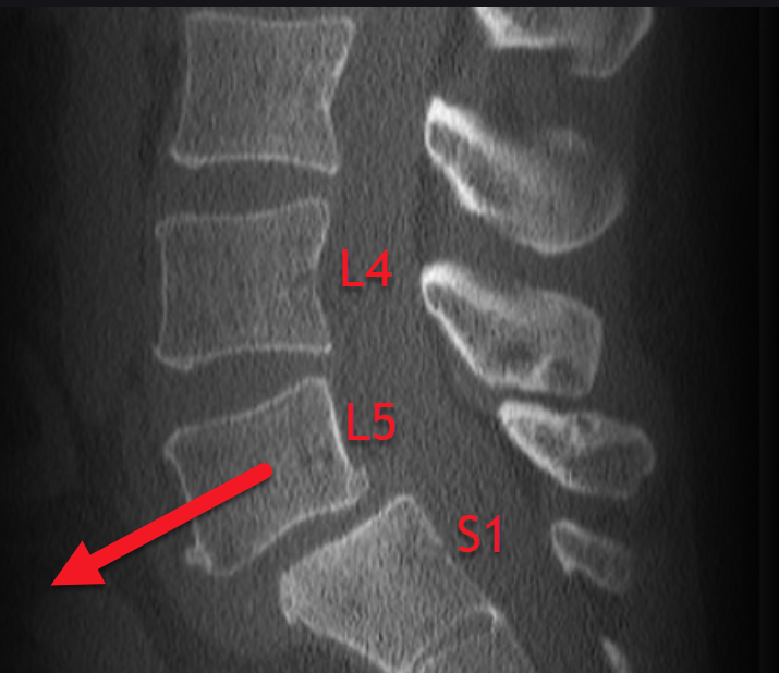 Spondylolisthesis and gymnastics OsteoMag