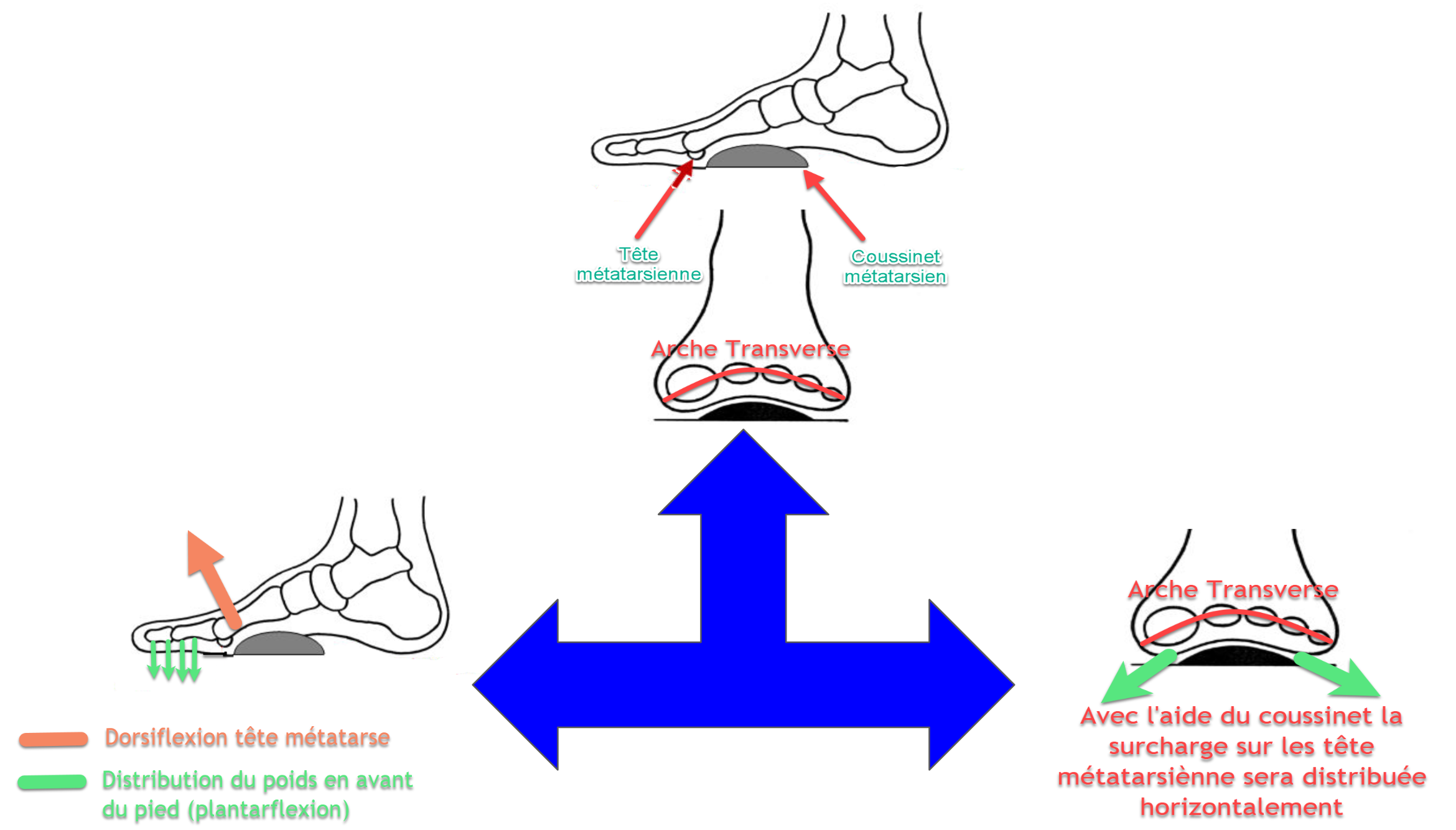 How to use the metatarsal pad | OsteoMag